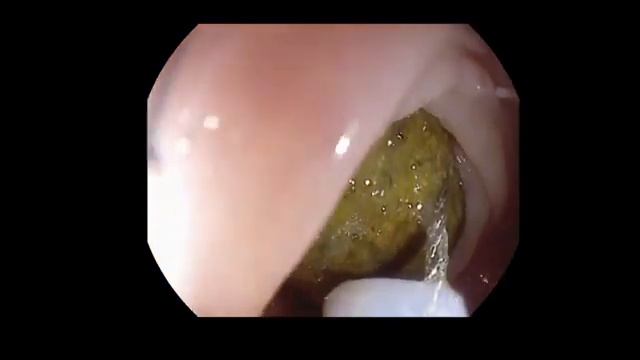 Безоары Удаление образований из желудка смотреть онлайн