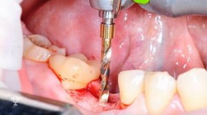 Разбор операции: имплантация сорок шестого зуба