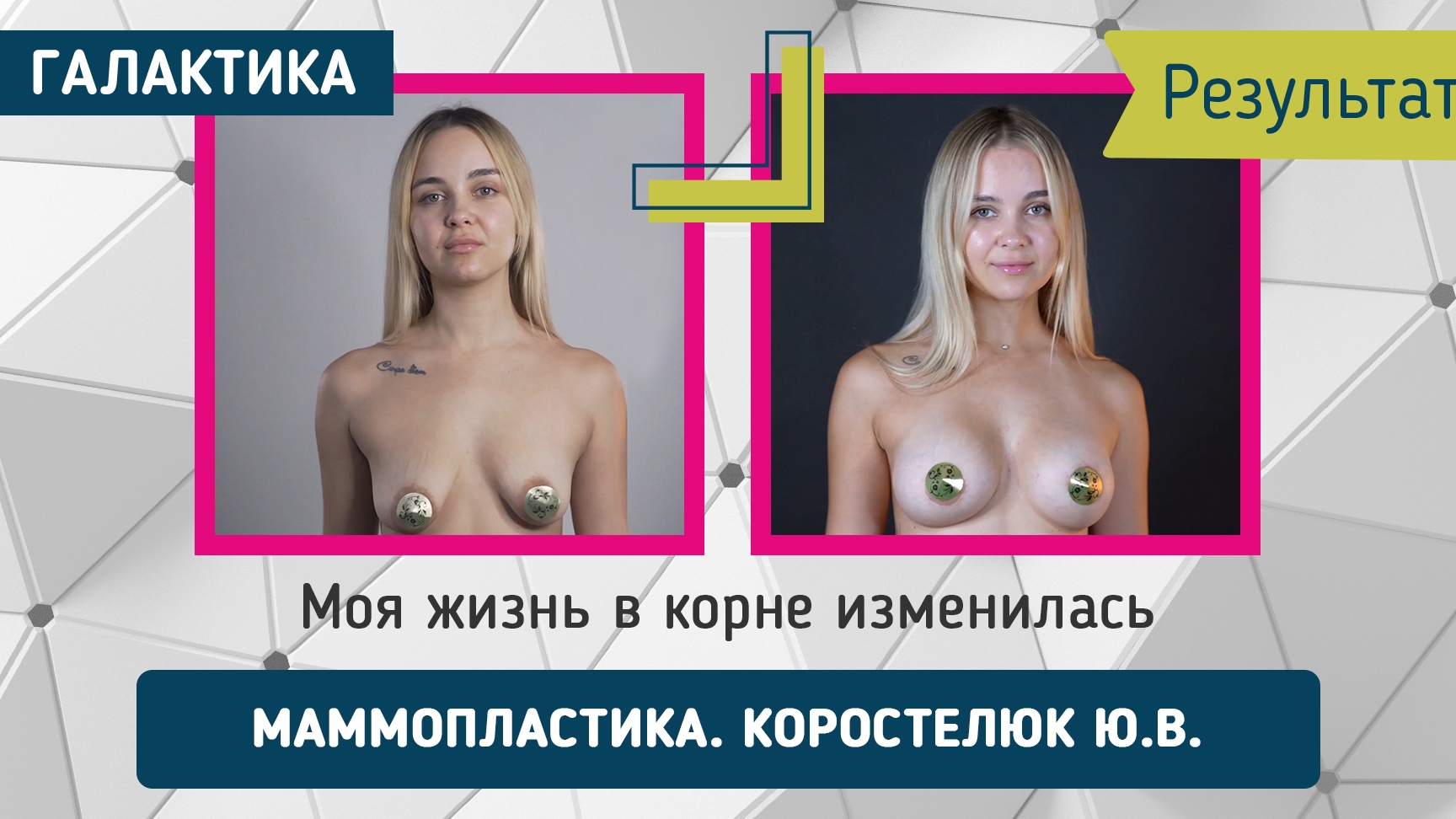Маммопластика через полгода | Коростелюк Юрий Витальевич