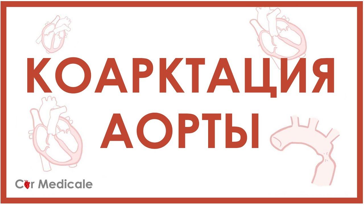 Коарктация аорты смотреть онлайн