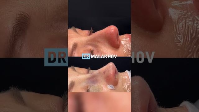 Первичная риносептопластика + трансконьюктивальная блефаропластика с перемещением грыж