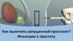 Лечение простатита. Инъекции в простату
