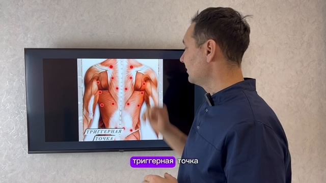 Что такое триггерные точки? Что делать если они появляются?#доктор #реабилитацияпослеинсульта