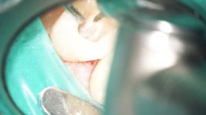 Болит зуб после удаления нерва - что делать?