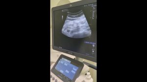 УЗИ желудка и кишечника. Комментарии врача. Медицинская клиника Ультрамед.