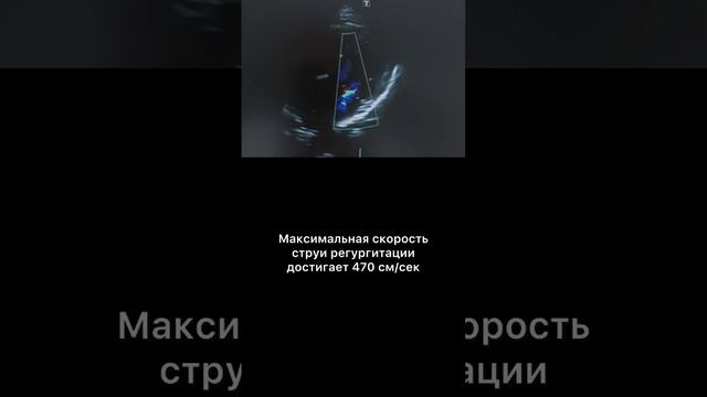 #митральнаянедостаточность