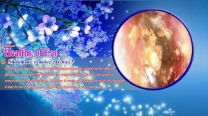 удаление холестеатомы #04