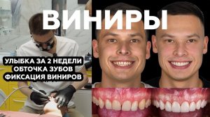 Керамические виниры: обточка, фиксация и финальный результат