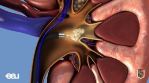 Ролик ЕАУ-РОУ "Уретероскопия"