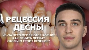 Рецессия десны: оголение корней зубов. Что делать?