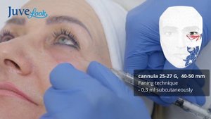 Treatment protocol Juvelook.