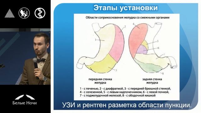 Рентгенохирургическая перкутанная пункционная гастростомия. Цепенщиков, Неклюдова, Абсалямов, Лядов