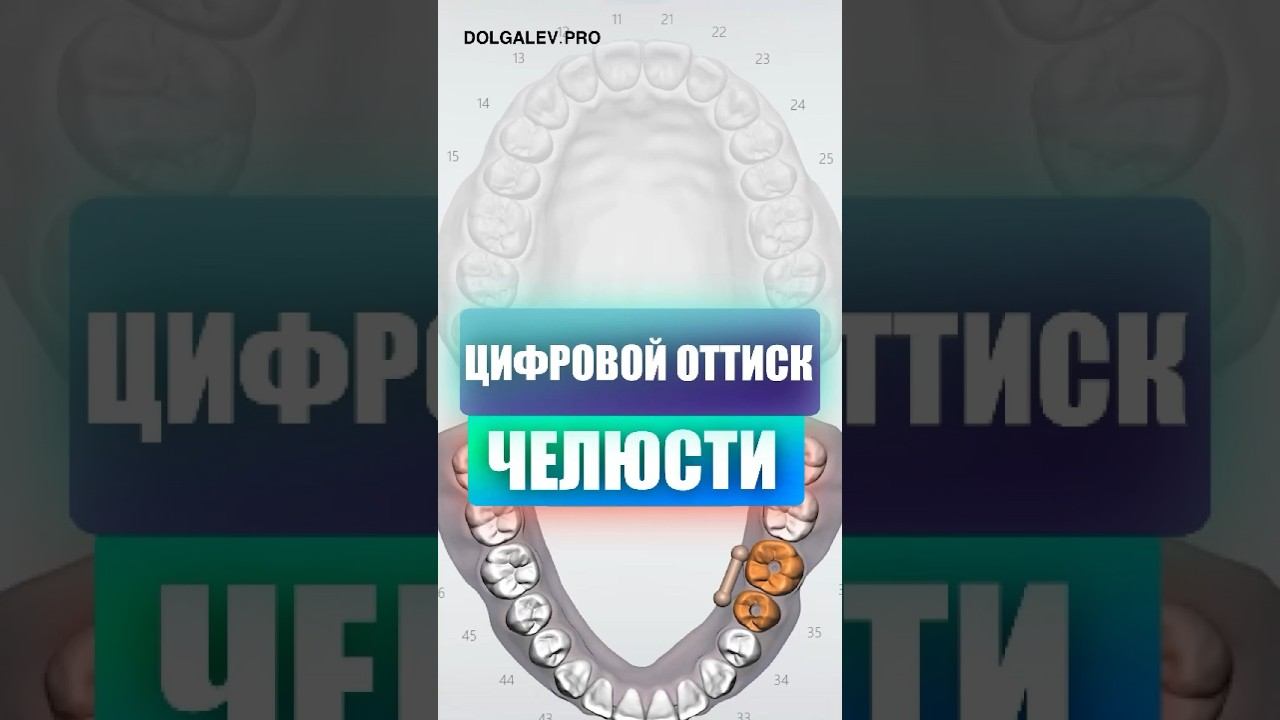 Как делать цифровой оттиск челюсти #имплантациязубов #имплант #импланты #цифровое #сканирование