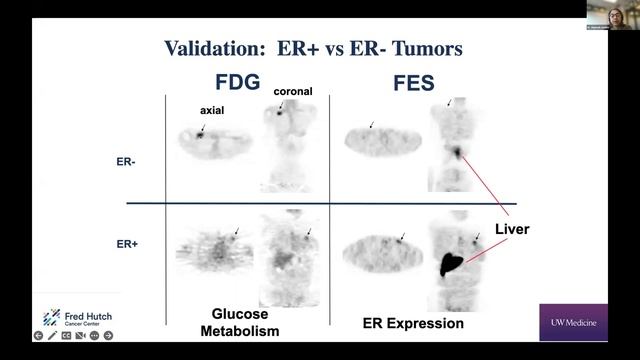 The Impact of Targeted Estrogen Receptor (ER) Imaging on Breast Cancer Patients смотреть онлайн