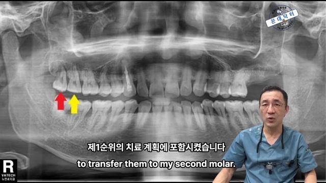 크랙 치아 발치 후 임플란트 대신 사랑니 자가치아이식 수술  Wisdom tooth transplant
