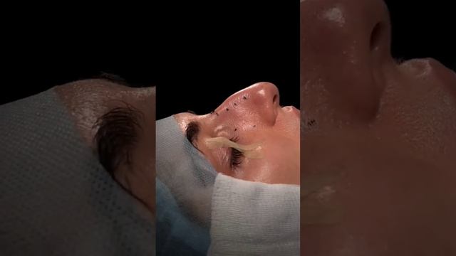 Пластика носа 👃 #пластиканоса