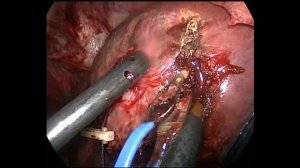 Pure laparoscopic liver resection: Wedge in segment 7