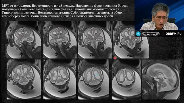 МРТ-диагностика аномалий головного мозга. Часть 1