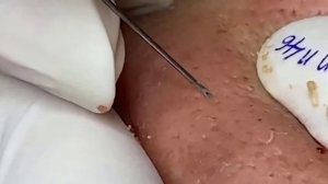 Удаление черных точек 2021