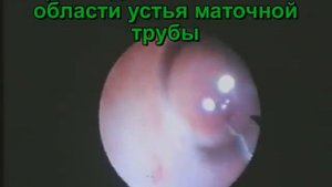 Спайки в маточных трубах. Лечение.