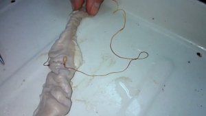 1 ушивание поперечной раны