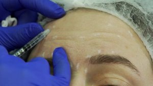 Техника инъекциий full-face ботулотоксина NEURONOX