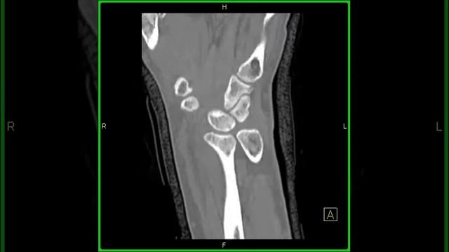 Musculoskeletal: Wrist trauma: Axial смотреть онлайн