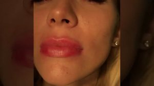 Максим Иванчук: Как сделать пышные губы? Увеличение губ гиалуроновой кислотой