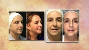 Changes Medical Spa & Laser Center | WJHL | Fotona 4D Laser Facelift