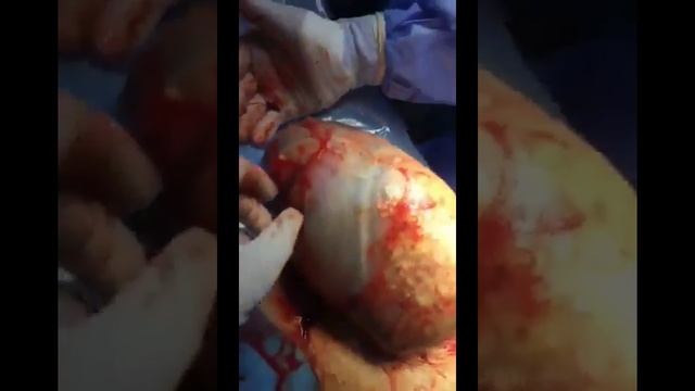 Baby born inside the amniotic sac (The miracle of life)..