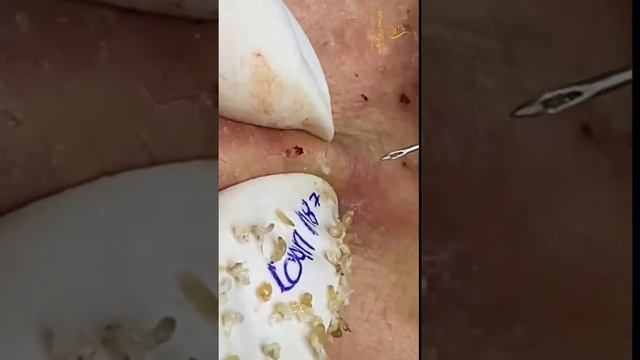 blackheads on back 2 смотреть онлайн