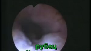 Эндометриоз рубца матки. Коричневые выделения.