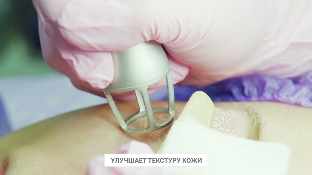 Лазерная блефаропластика