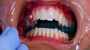 Офисное отбеливание Opalescence Boost