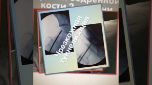 Асептический некроз головки бедренной кости  2 степени