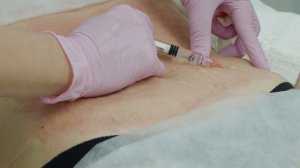 Сочетанное применение препарата Profhilo Body и микроигольчатого RF-лифтинга в области живота.