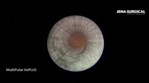 Гольмиевый лазер Камень почки 1,5см. Литотрипсия на аппарате MultiPulse HoPLUS.