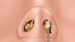 ASMR Nose Mucus Deep Cleaning Animation | Massive Booger and Unmanaged Piercing Removal