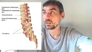 Как вылечить грыжу без операций #протрузия #экструзия
