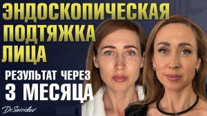 Эндоскопическая подтяжка верхней зоны лица: результат через 3 месяца / До - После / Сергей Свиридов