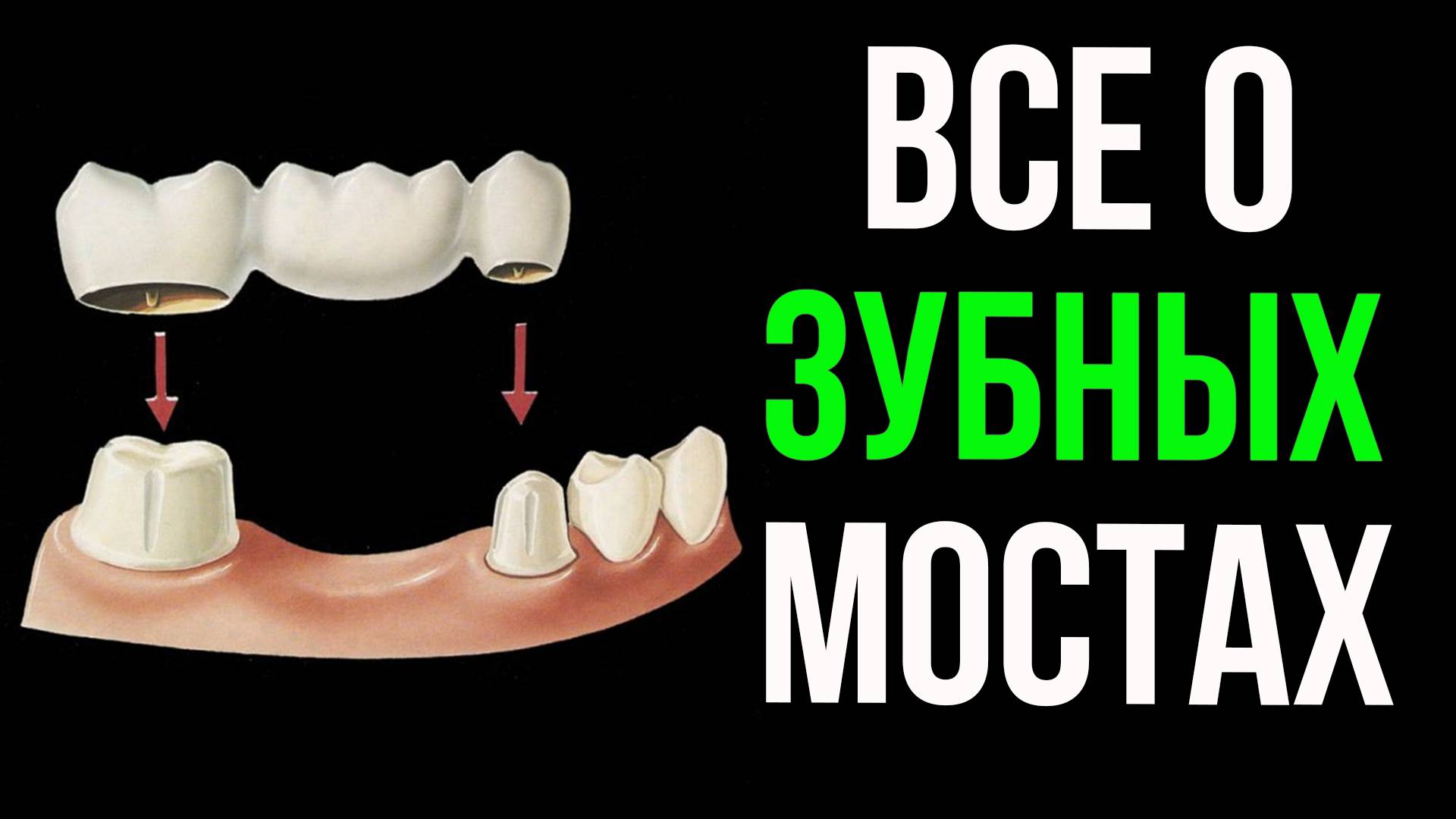 Зубные мосты: всё, что нужно знать! Виды, материалы, плюсы и минусы