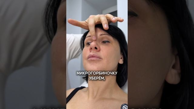 Больше про Ринопластику и другие операции у меня в профиле, переходи и смотри😉