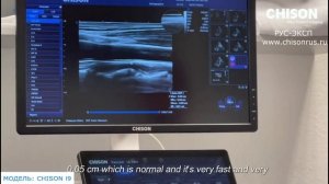 CHISON i9 обзор УЗИ аппарата экспертного класса
