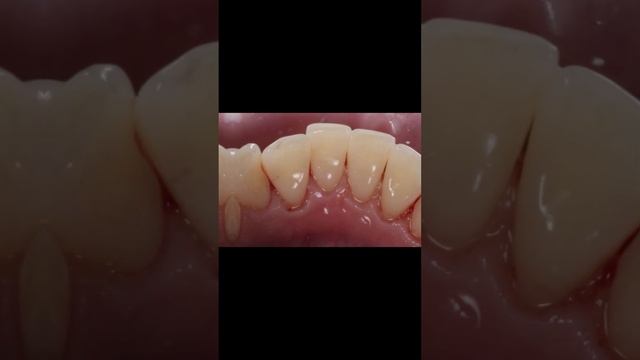 Гигиена зубов - До/После. Наводим порядок! #доктор #стоматологияновосибирск смотреть онлайн