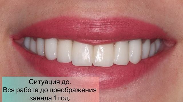 Преображение улыбки. Улучшение качества жизни пациента!