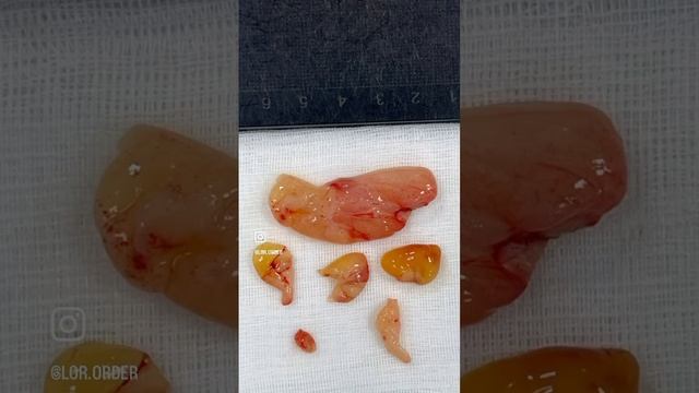 Это не давало дышать: удалил огромный полип из носа. смотреть онлайн