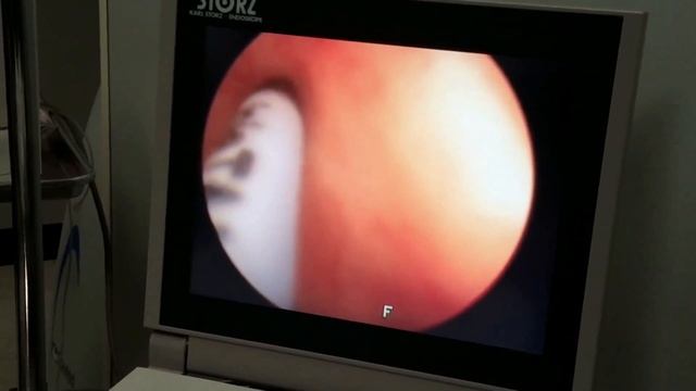 Bladder Botox actual procedure смотреть онлайн