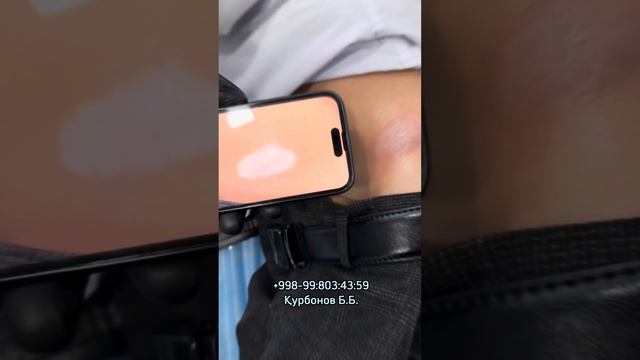 Vitiligo yangi usulda oq dog’larni yopish! смотреть онлайн