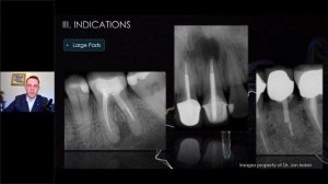 CE WEBINAR: Advancements in Endodontic Apical Microsurgery by Jon Irelan D.D.S. M.S. and ZEISS