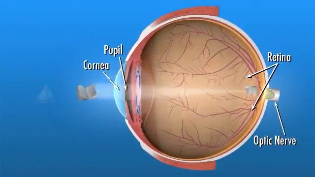 IOL Intraocular Lens смотреть онлайн